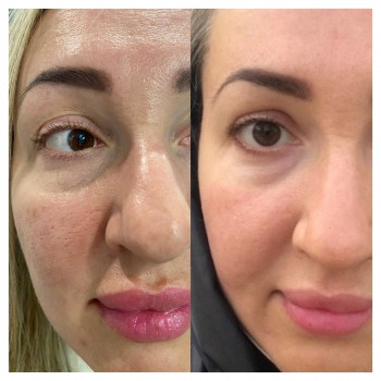 Плазменная шлифовка
                    Косметолог Елена Харків