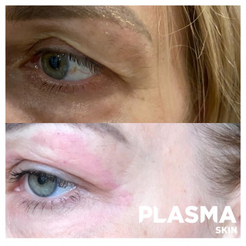 Плазменная шлифовка
                    Косметолог Елена Харків