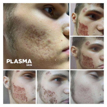 Плазменная шлифовка
                    Косметолог Елена Харків