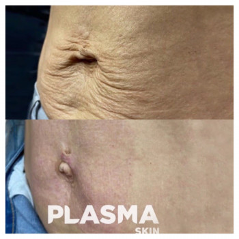 Плазменная шлифовка
                    Косметолог Елена Харків