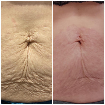 Плазменная шлифовка
                    Косметолог Елена Харків