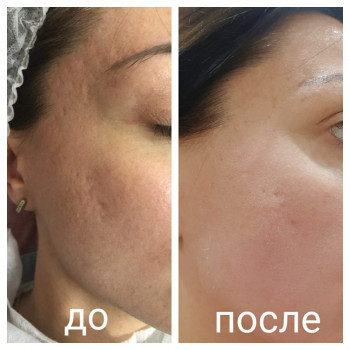 Плазменная шлифовка
                    Косметолог Елена Харків