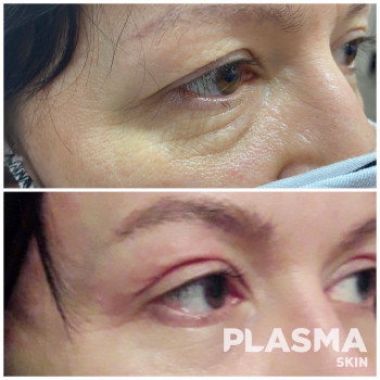 Плазменная шлифовка
                    Косметолог Елена Харків