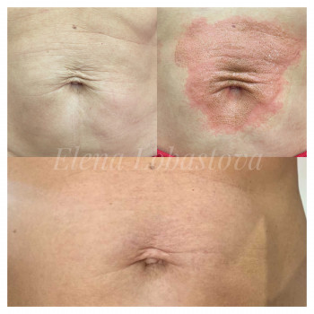 Плазменная шлифовка
                    Косметолог Елена Харків