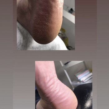 Магія✨

Апаратний педикюр