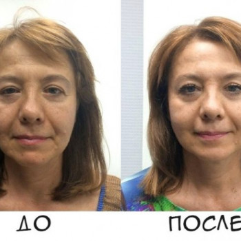 Гуа-ша массаж лица
                    Массажист Вика Одесса