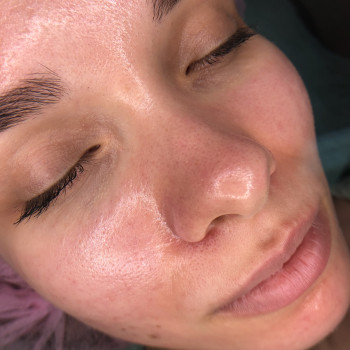 Пилинг салицилово-азелаиновый