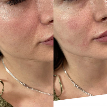 Контурная пластика скул
                    Косметолог Дарья Маріуполь