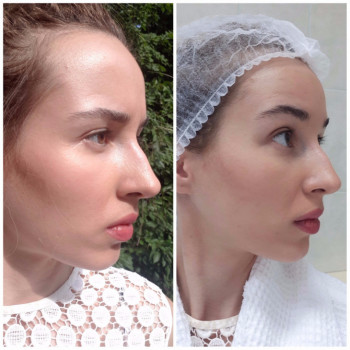 Контурная пластика скул
                    Косметолог Дарья Маріуполь