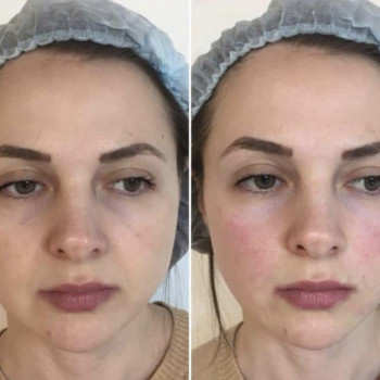 Контурная пластика скул
                    Косметолог Дарья Маріуполь