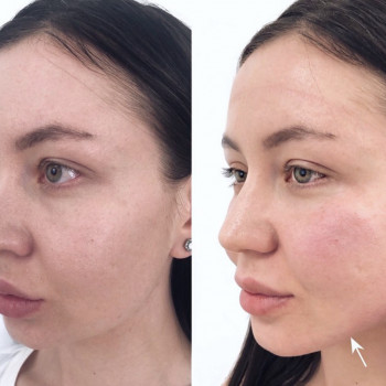 Контурная пластика скул
                    Косметолог Дарья Маріуполь