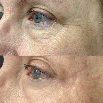 Блашинг поверхностное заполнение морщин
                    Косметолог Дарья Мариуполь