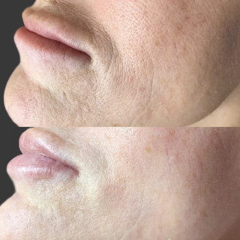 Блашинг поверхностное заполнение морщин
                    Косметолог Дарья Мариуполь