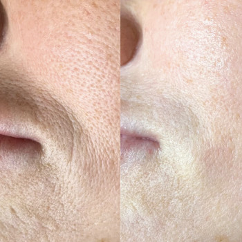 Блашинг поверхностное заполнение морщин
                    Косметолог Дарья Мариуполь