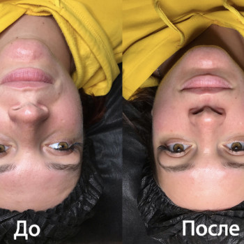 до и после
карбокситерапия Peptide prime orchid (1 процедур