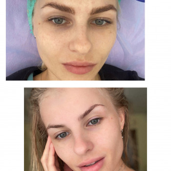 Результат после курса (5ти процедур карбонового пилинга)