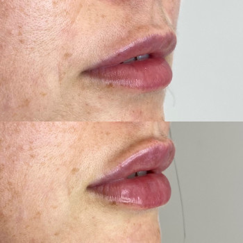 Контурная пластика губ. Neuramis 1 ml