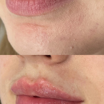 Контурная пластика губ. Neuramis 1 ml