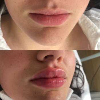 Контурная пластика губ. Neuramis 1 ml