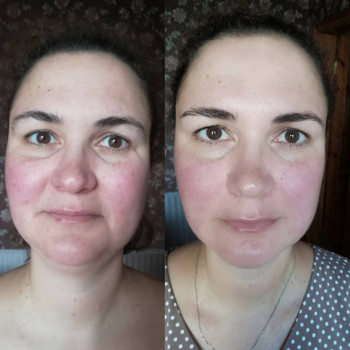 Скульптурный лифтинг лица, буккальный
                    Массажист Евгения Киев