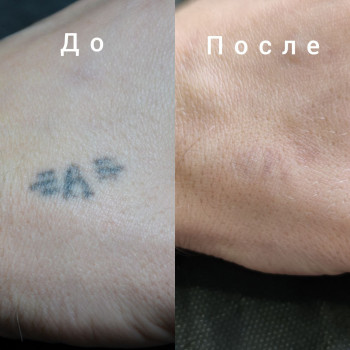 Лазерное удаление тату и татуажа
                    Бровист Діана Белая Церковь