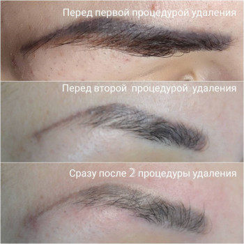 Лазерное удаление тату и татуажа
                    Бровист Діана Белая Церковь