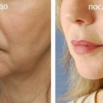 Мезонити Тредлифтинг
                    Косметолог Дарья Мариуполь