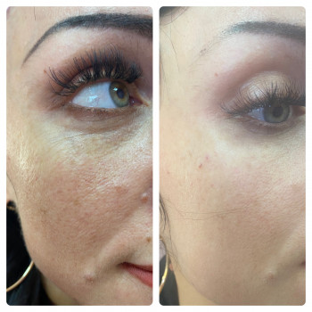 Мезонити Тредлифтинг
                    Косметолог Дарья Мариуполь