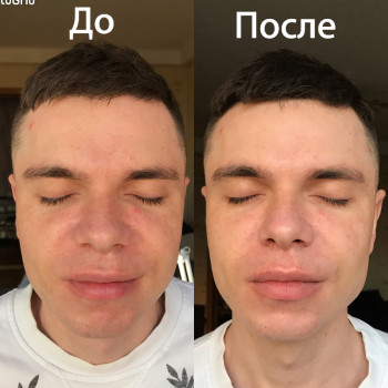 Эпидермальная пептидная карбокситерапия Demax Peptide prime 