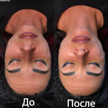 Эпидермальная пептидная карбокситерапия Demax Peptide prime 