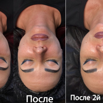 Эпидермальная пептидная карбокситерапия Demax Peptide prime 