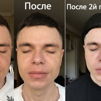 Эпидермальная пептидная карбокситерапия Demax Peptide prime 