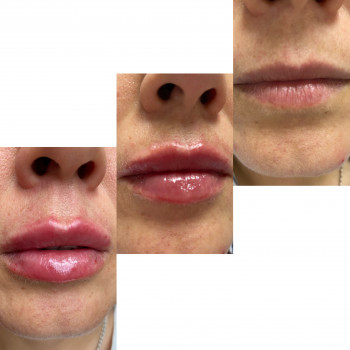 Зволоження та корекція губ