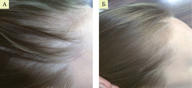 диффузная телогеновая алопеция