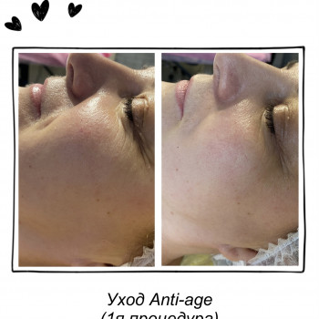 уход за лицом, коррекция морщин