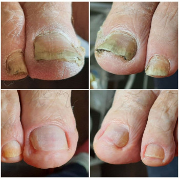 Аппаратный педикюр
                    Салон красоты BeautySkin Киев