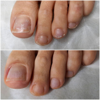 Аппаратный педикюр
                    Салон красоты BeautySkin Киев