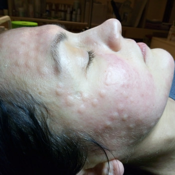 Мезотерапия лица, шеи и декольте
                    Салон красоты BeautySkin Киев