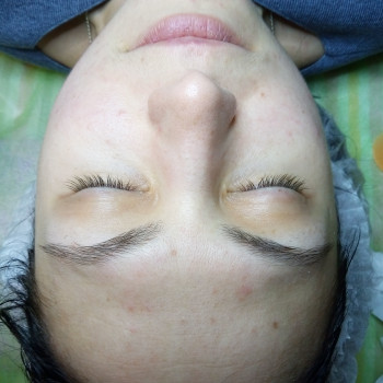 Мезотерапия лица, шеи и декольте
                    Салон красоты BeautySkin Киев