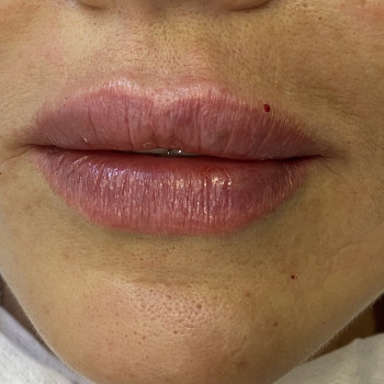 Juviderm ultra smile 0,55