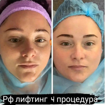 RF ліфтинг на апараті Zemits
                    Косметолог Лілія Винница