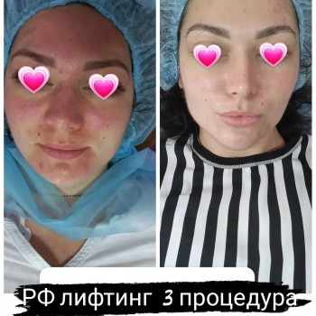 RF ліфтинг на апараті Zemits
                    Косметолог Лілія Винница