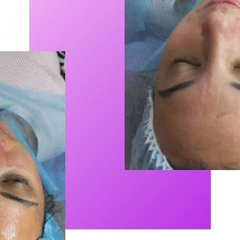 Карбоксітерапія
                    Косметолог Лілія Вінниця