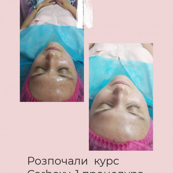 Карбоксітерапія
                    Косметолог Лілія Вінниця
