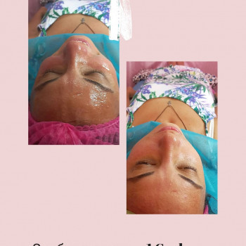 Карбоксітерапія
                    Косметолог Лілія Вінниця