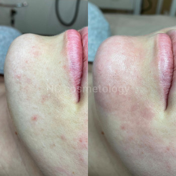 Чистка лица
                    Салон краси NC Cosmetology Київ