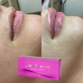 Контурная пластика губ препаратом JUVEDERM ULTRA SMILE
                    Салон красоты NC Cosmetology Киев
