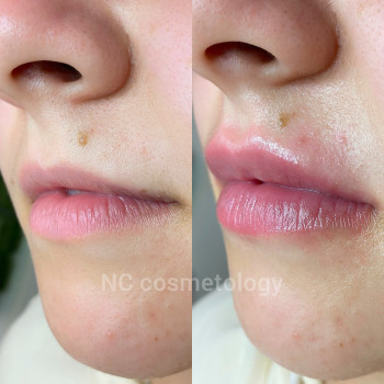 Контурная пластика губ препаратом JUVEDERM ULTRA SMILE
                    Салон красоты NC Cosmetology Киев