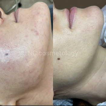 Миндальный пилинг Simildiet
                    Салон красоты NC Cosmetology Киев
