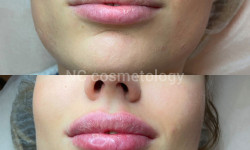 Контурная пластика губ препаратом NEURAMIS DEEP Салон красоты NC Cosmetology Киев